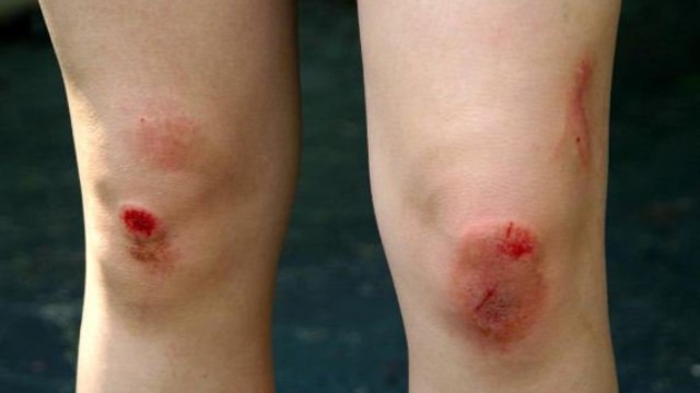 Tác hại khi sử dụng kem nghệ bôi lên vết thương hở