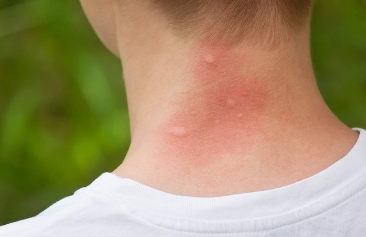 cách đuổi muỗi trong phòng nhanh và hiệu quả nhất