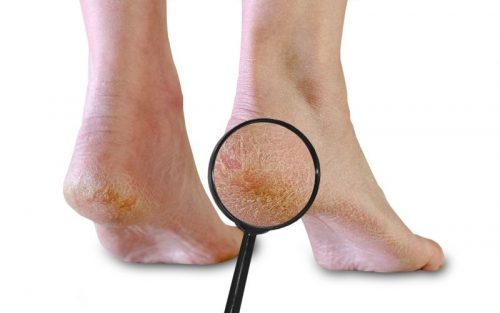 Việc sử dụng các thành phần tự nhiên hay sử dụng các loại kem để trị nứt nẻ gót chân tùy thuộc vào nhu cầu mục đích sử dụng và sở thích của bạn