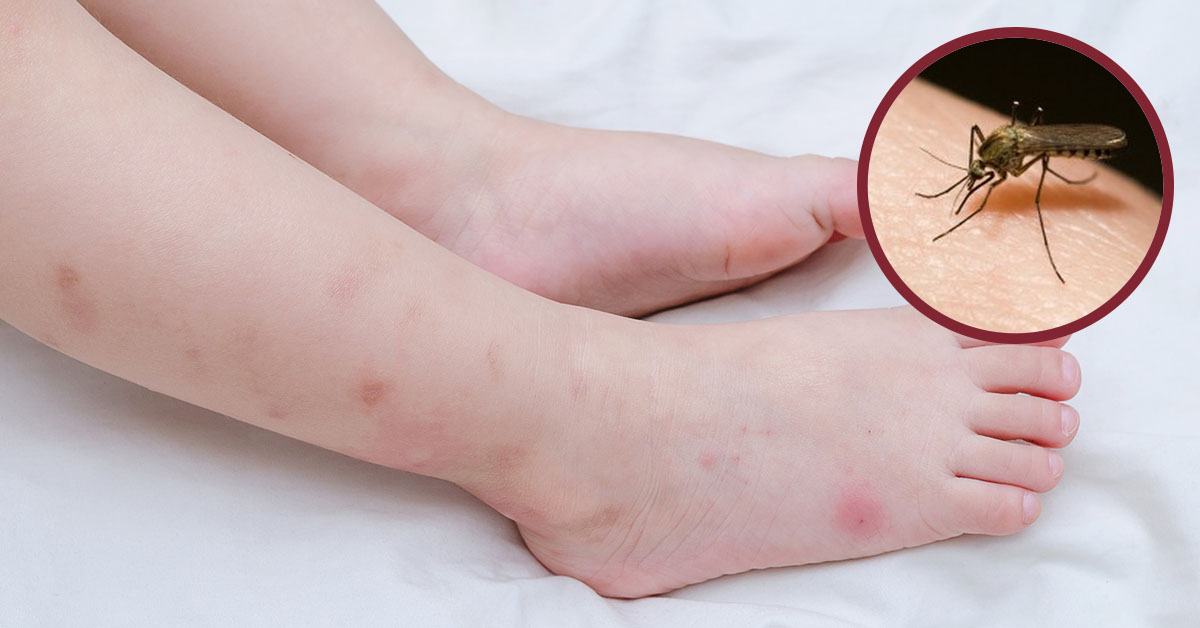 Cách đuổi muỗi trong nhà phòng sốt xuất huyết