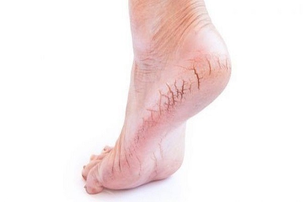 Các dấu hiệu của triệu chứng khô, nứt gót chân là gì