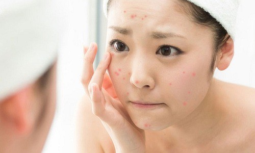 Thay đổi nội tiết tố là nguyên nhân chính gây nên mụn 