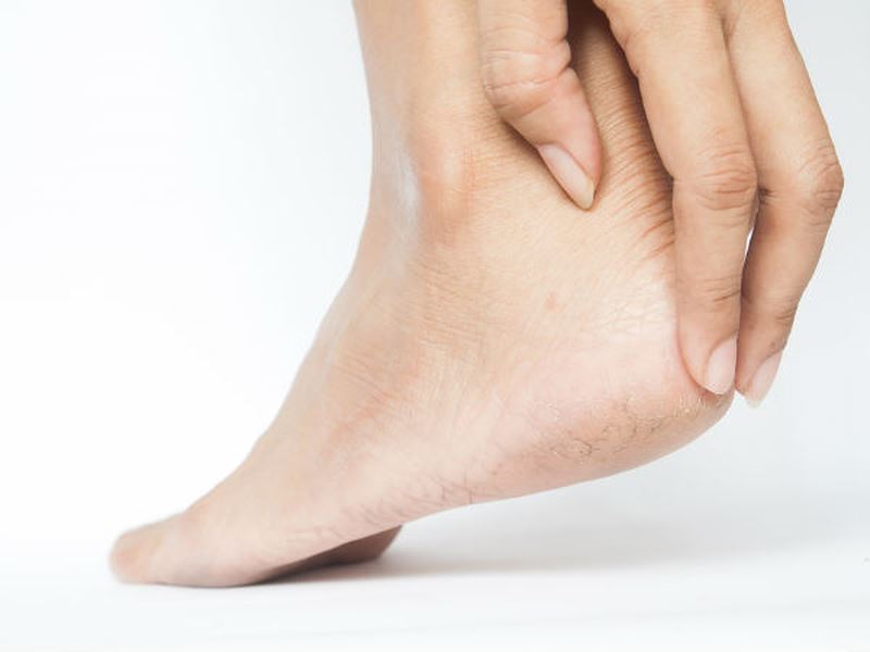 Bà bầu có nên dùng kem nẻ gót chân không?